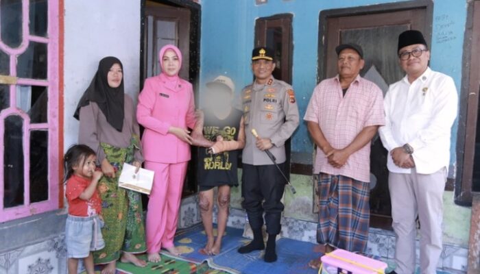 Kapolda NTB Jenguk Korban Tersulut Api di Ponpes di Lombok Tengah, Janji Kawal Restitusi dan Tuntaskan Kasus
